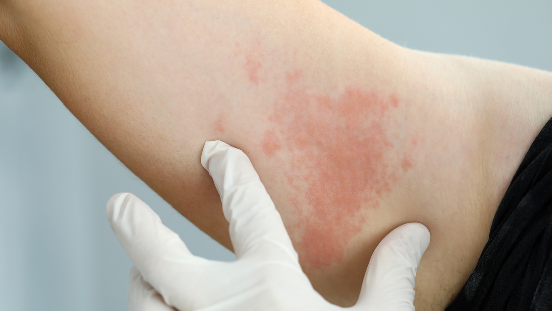 Histamina i jej rola w organizmie