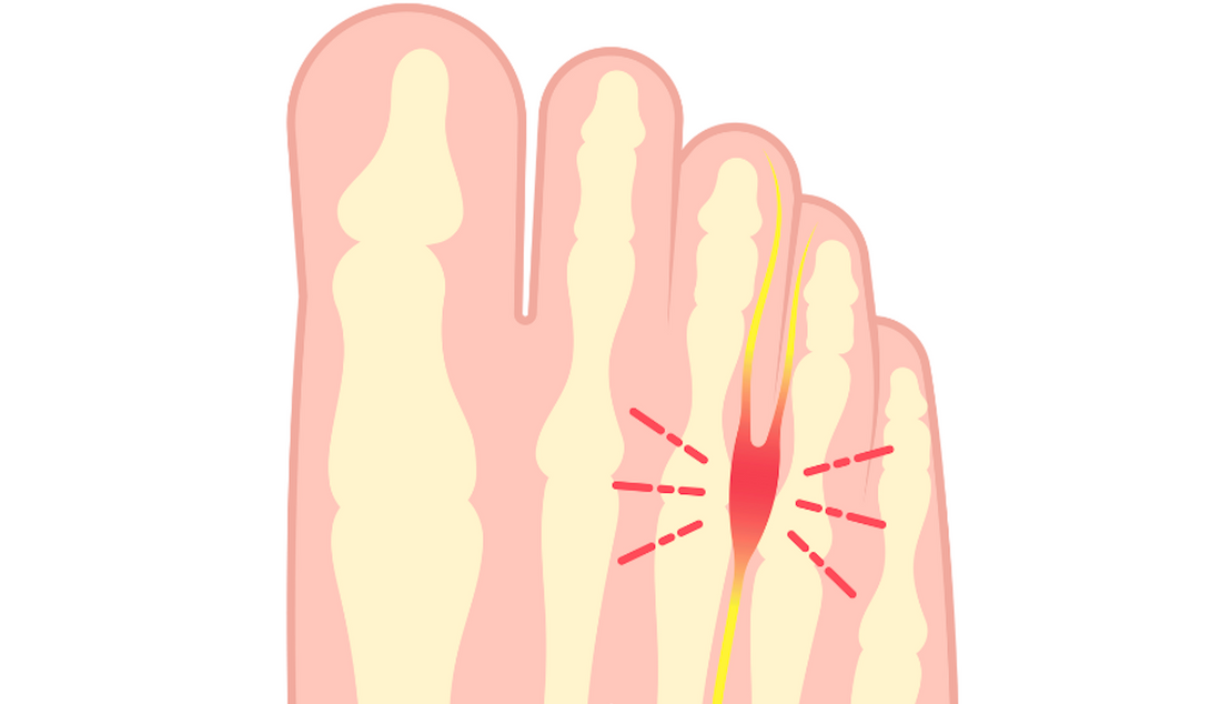 Neuralgia Mortona i Ortopedyczne Wkładki Medicovi H20